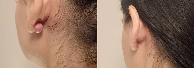 Earlobe Revision Surgery in Scottsdale & Avondale, AZ