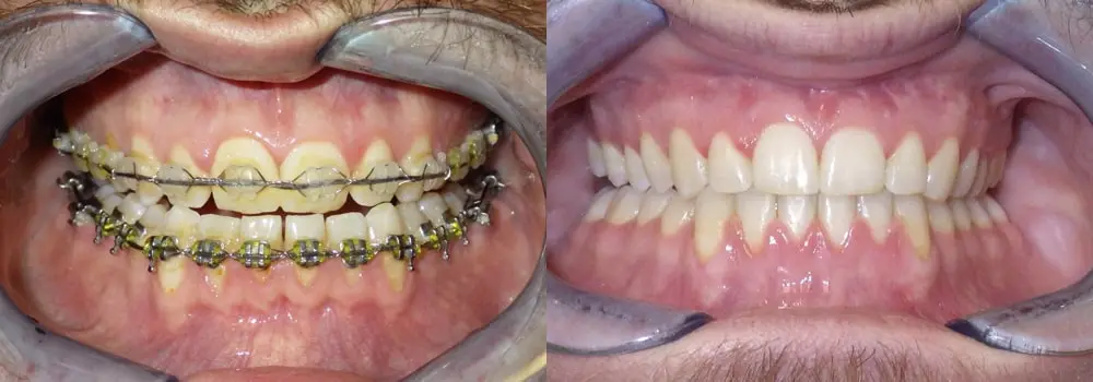 Corrective Jaw Surgery Before/After Photo in Scottsdale & Avondale, AZ