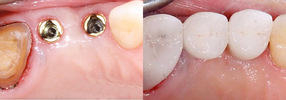 Dental Implant Before/After Photo At Guyette Facial & Oral Surgery