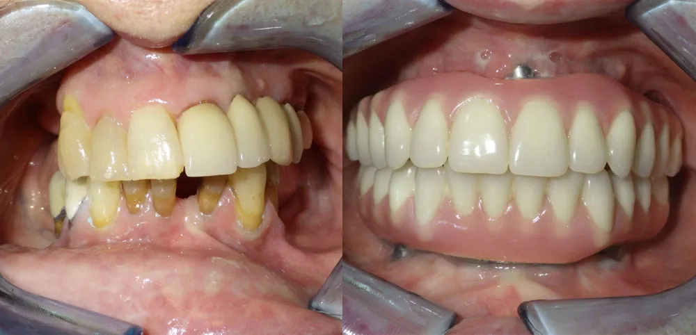 All-on-4 Dental Implant Before/After in Scottsdale & Avondale, AZ