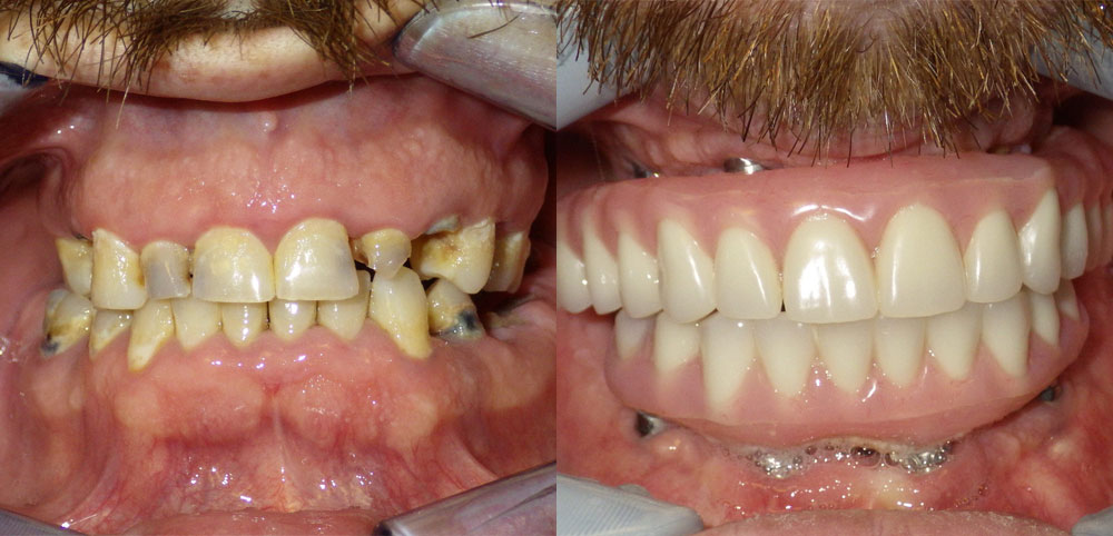 Before and after image of a female who got dental implant in Scottsdale & Avondale, AZ
