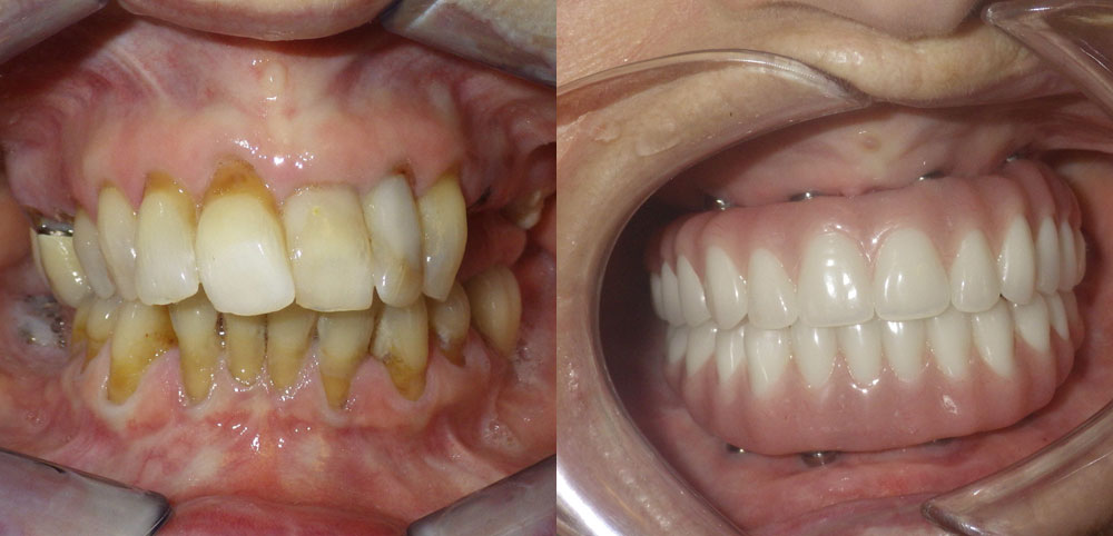 All-on-4 Dental Implant Before/After in Scottsdale & Avondale, AZ