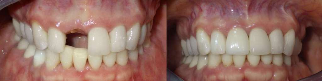 Immediate Tooth Replacement in Scottsdale & Avondale, AZ