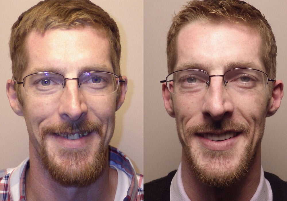 Before & after image of a 35 yr old male who got orthognathic treatment in Scottsdale & Avondale, AZ
