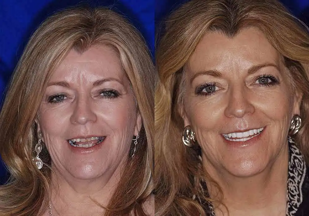 Before and After of All-on-4 Dental Implants in Scottsdale & Avondale, AZ