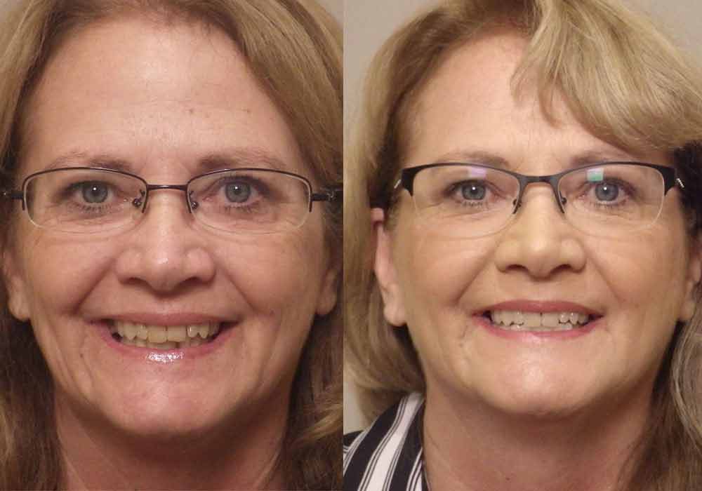 All-on-4 Dental Implant Before & After Picture in Scottsdale & Avondale, AZ 