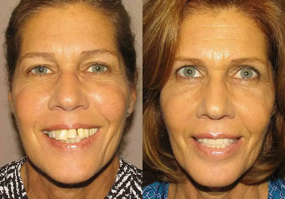 Pictures of Patient 3 All-on-4 Dental Implants in Scottsdale & Avondale, AZ
