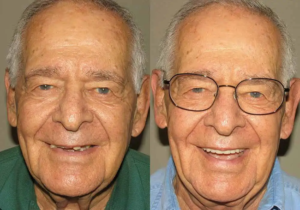 Pictures of Patient 6 All-on-4 Dental Implants in Scottsdale & Avondale, AZ