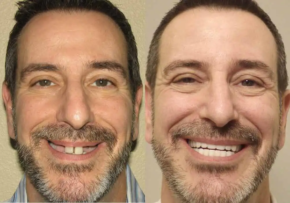 Pictures of Patient 9 All-on-4 Dental Implants in Scottsdale & Avondale, AZ
