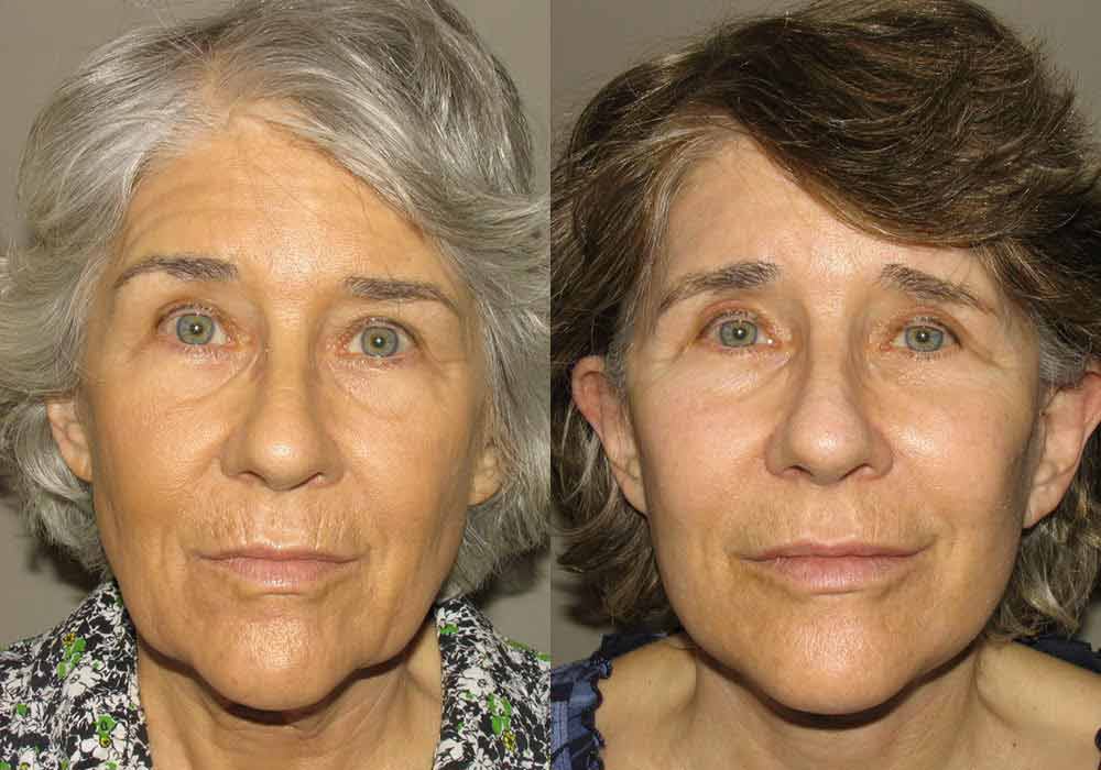 Facelift Before and After Pictures in Scottsdale & Avondale, AZ 