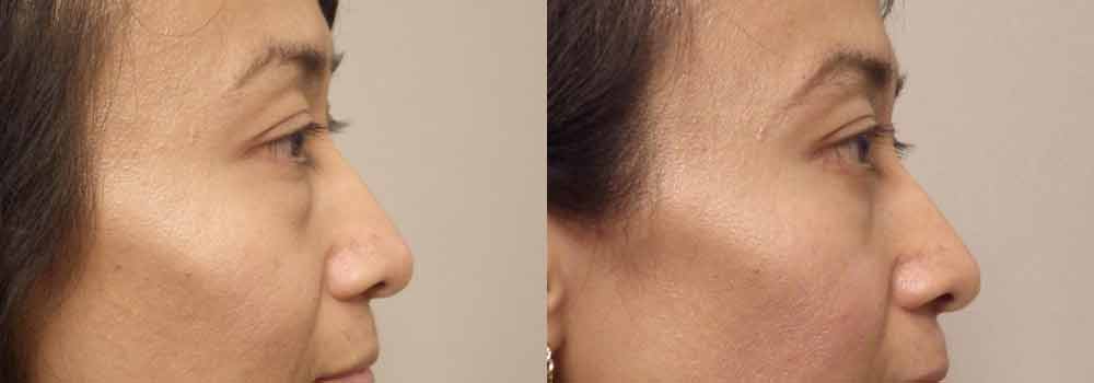 Before & After Pictures of Lower Eyelid Surgery in Scottsdale & Avondale, AZ