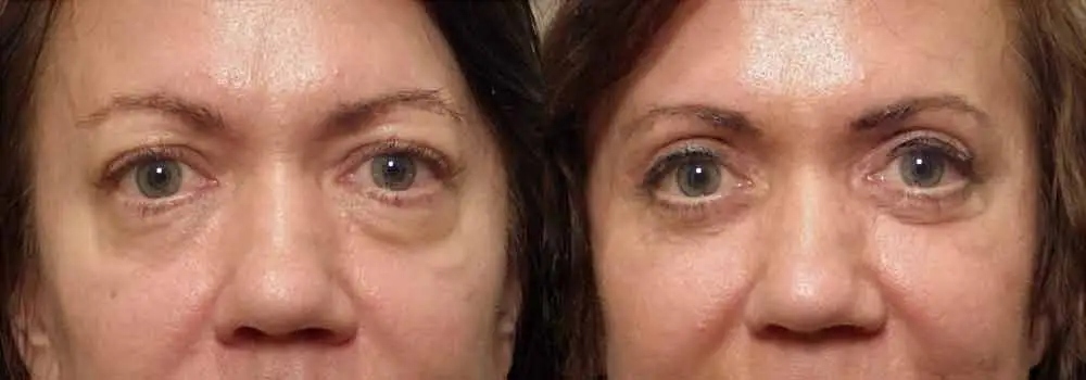 Before & After Pictures of Upper Eyelid Surgery in Scottsdale & Avondale, AZ