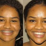 Before and After picture of corrective jaw surgery in Scottsdale & Avondale, AZ