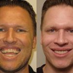 Patient's corrective jaw surgery treatment plan before and after in Scottsdale & Avondale, AZ