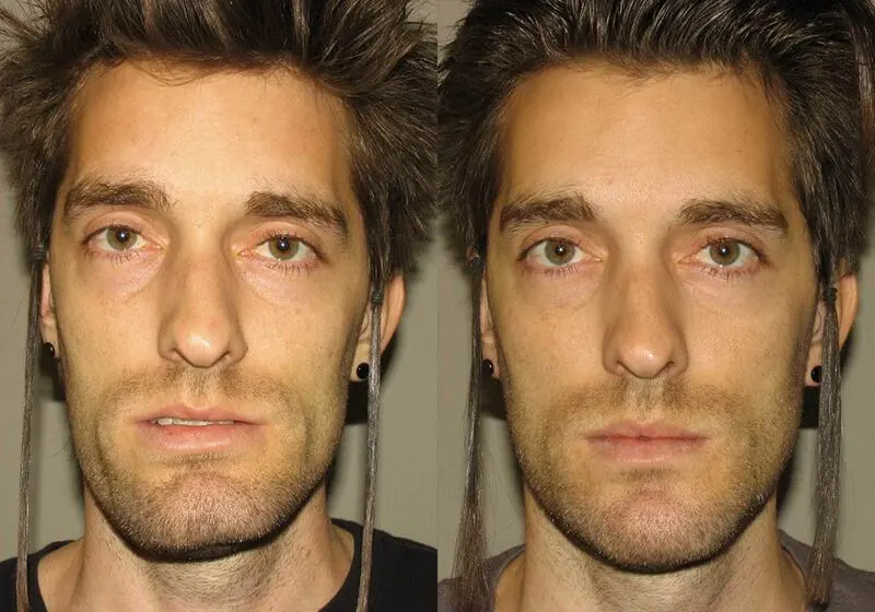 Front view of a man who got corrective jaw surgery in Scottsdale & Avondale, AZ