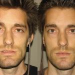Front view of a man who got corrective jaw surgery in Scottsdale & Avondale, AZ