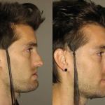 Before and After of Corrective Jaw Surgery in Scottsdale & Avondale, AZ