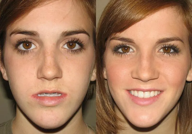 Front view of a young girl who got corrective jaw surgery in Scottsdale & Avondale, AZ
