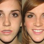 Front view of a young girl who got corrective jaw surgery in Scottsdale & Avondale, AZ