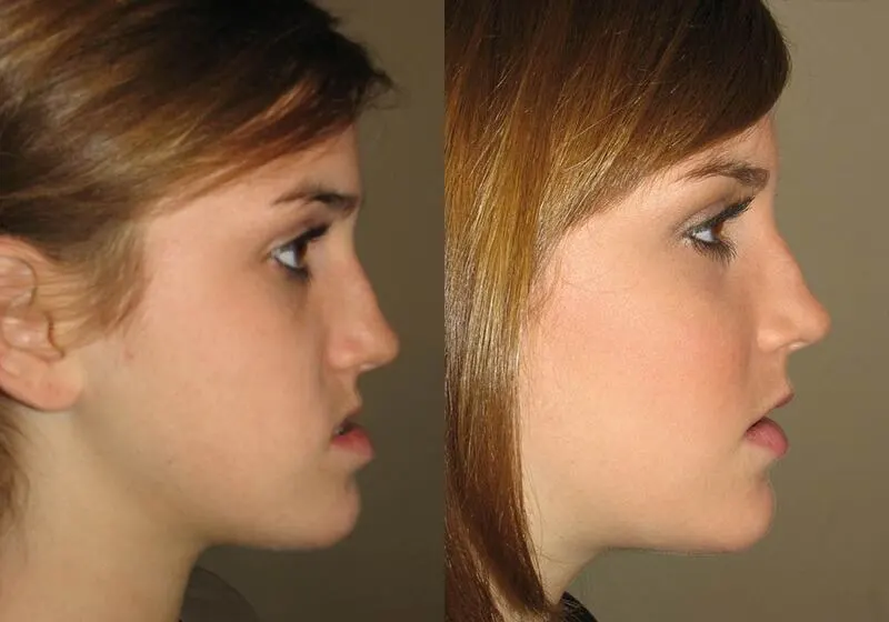 Side view of a girl who got corrective jaw surgery in Scottsdale & Avondale, AZ