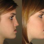 Side view of a girl who got corrective jaw surgery in Scottsdale & Avondale, AZ