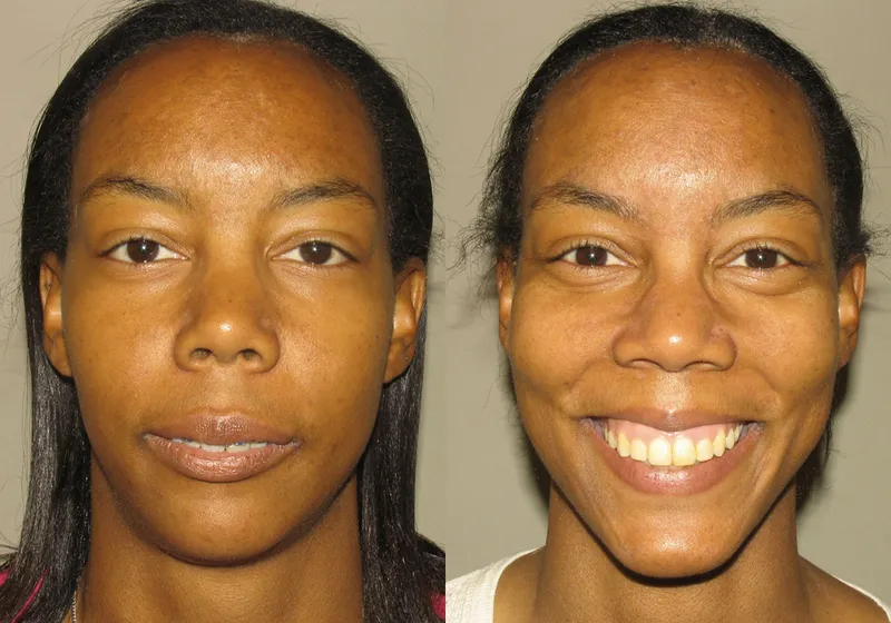 Front view of a woman who got corrective jaw surgery in Scottsdale & Avondale, AZ
