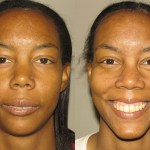 Front view of a woman who got corrective jaw surgery in Scottsdale & Avondale, AZ