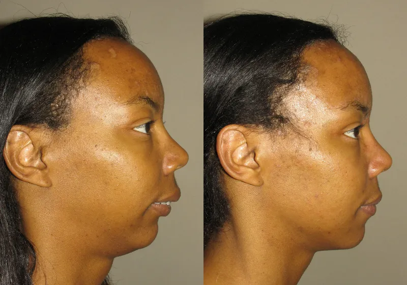 Before & after image of a woman who got corrective jaw surgery in Scottsdale & Avondale, AZ