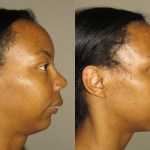 Before & after image of a woman who got corrective jaw surgery in Scottsdale & Avondale, AZ