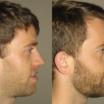 Before and after image of patient who got corrective jaw surgery in Scottsdale & Avondale, AZ