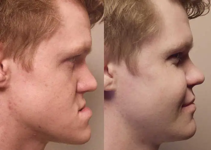 Side view of Corrective jaw surgery in Scottsdale & Avondale, AZ