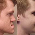 Side view of Corrective jaw surgery in Scottsdale & Avondale, AZ