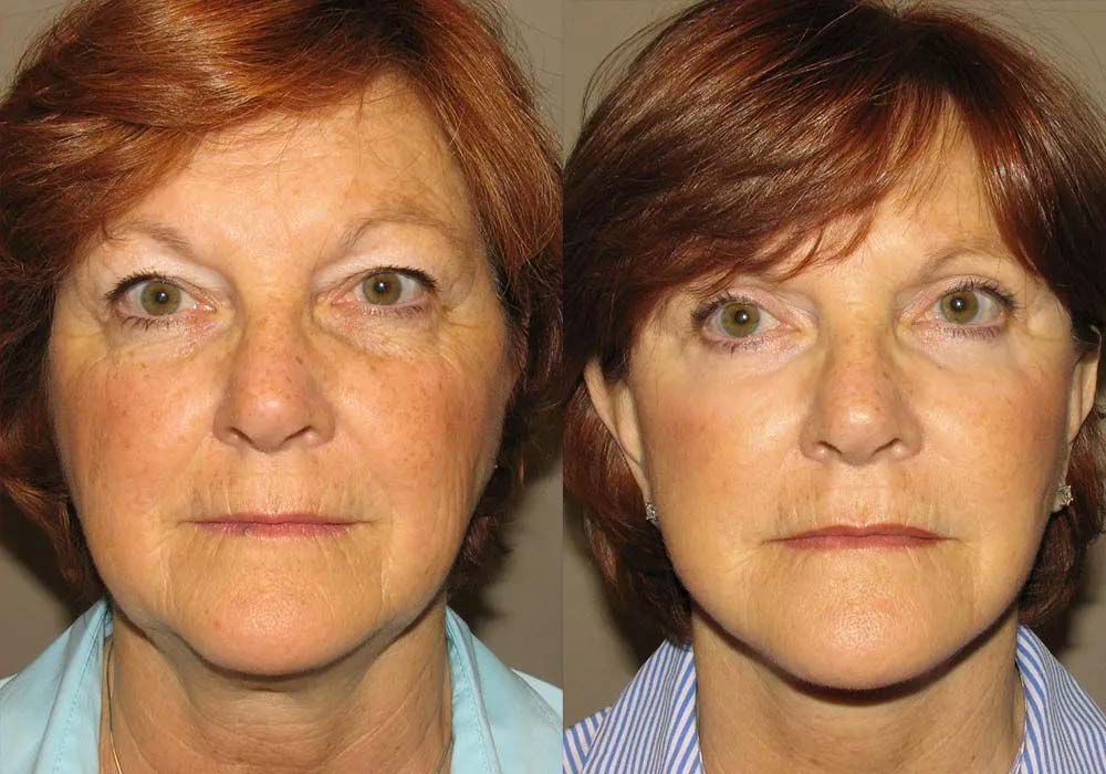 Results of a facelift procedure following treatment at Guyette Facial & Oral Surgery Center