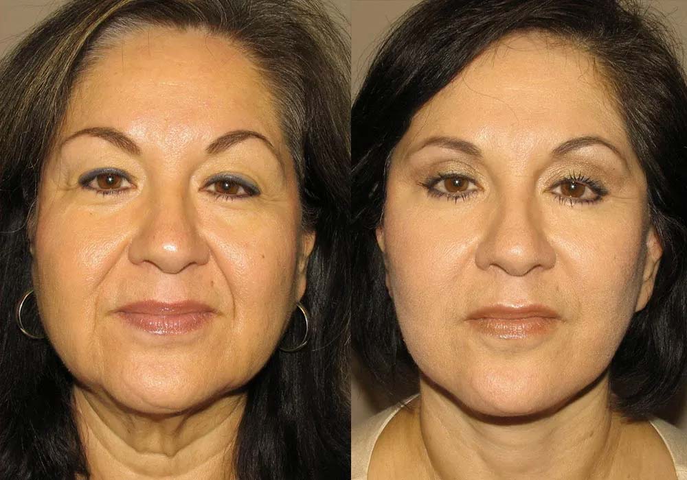 Facelift procedure results shown in before and after images from Scottsdale & Avondale, AZ