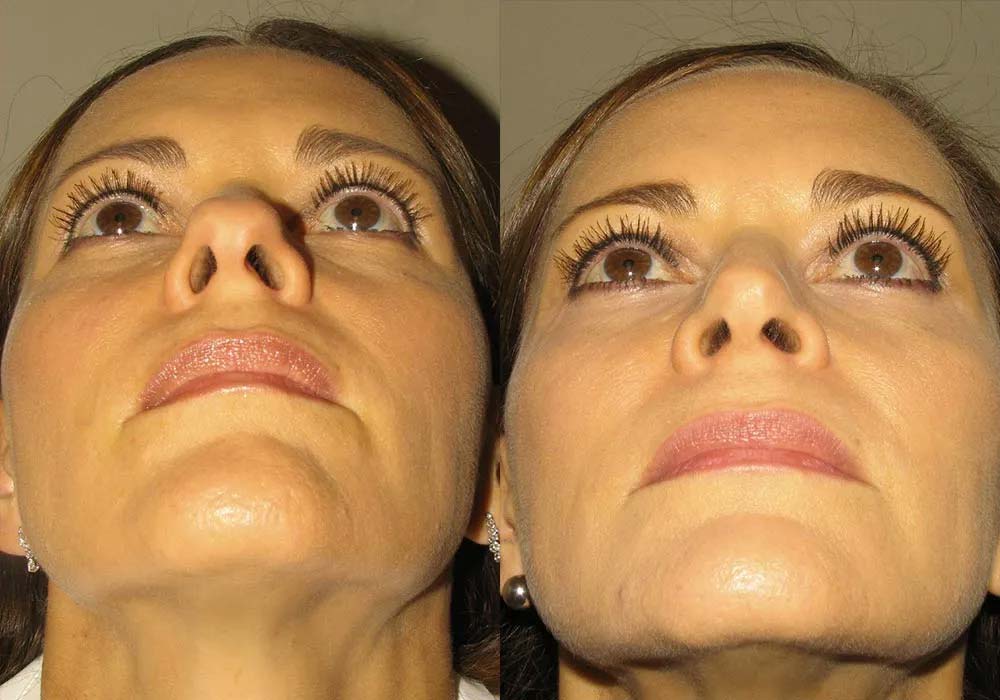 Rhinoplasty procedure before and after photos demonstrating the results in Scottsdale & Avondale, AZ