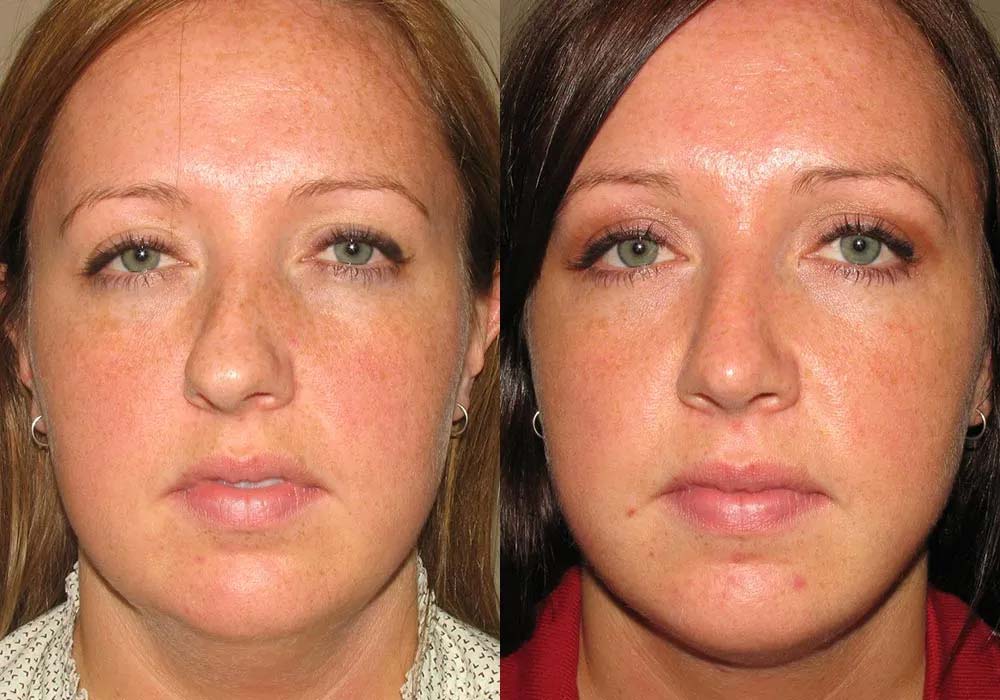 Rhinoplasty patient before & after photos highlighting the results in Scottsdale & Avondale, AZ