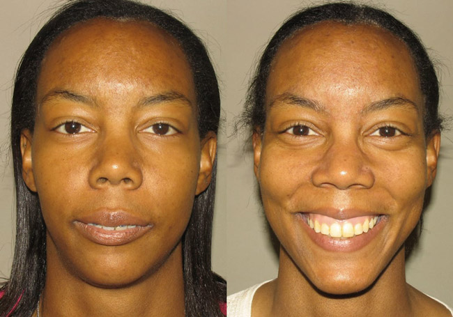 Corrective Jaw Surgery Before and After Photos in Scottsdale & Avondale, AZ.